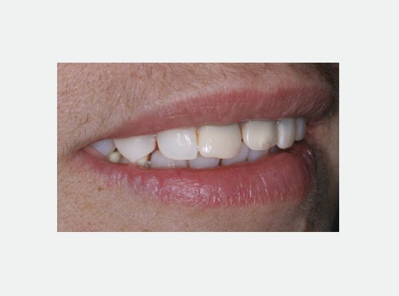 casos-clinicos-dr-jansen-ozaki-e-dr-waldir-romao-jr-10