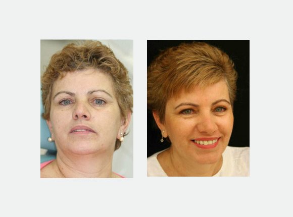 casos-clinicos-dr-jansen-ozaki-e-dr-waldir-romao-jr-12