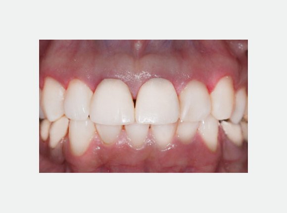 casos-clinicos-dr-jansen-ozaki-e-dr-waldir-romao-jr-4