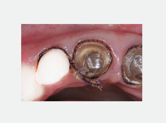 casos-clinicos-dr-jansen-ozaki-e-dr-waldir-romao-jr-5