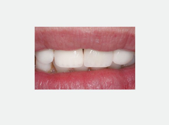 casos-clinicos-dr-jansen-ozaki-e-dr-waldir-romao-jr-9