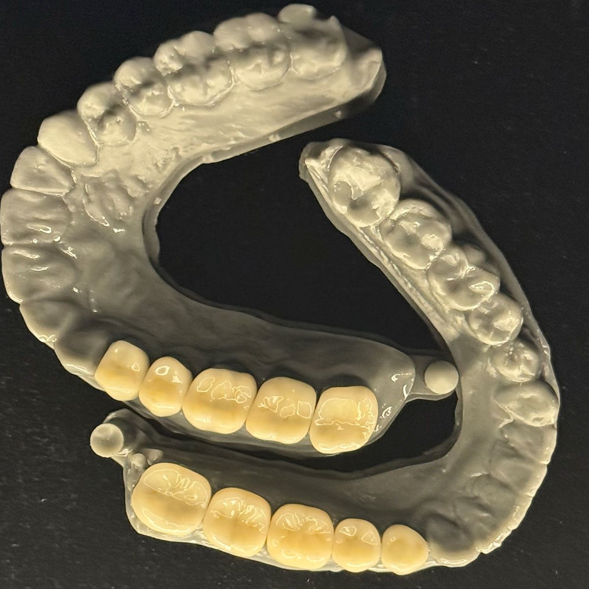 COROA TOTAL FIXA DE ZIRCONIA DIGITAL_