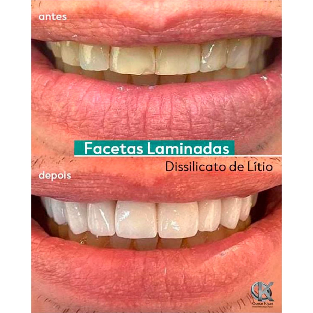 Facetas Laminadas