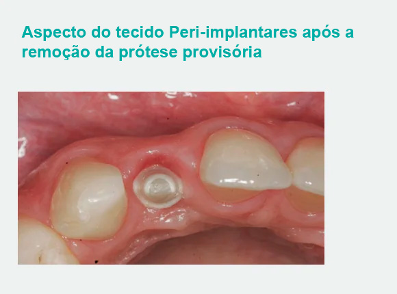Aspecto do tecido Peri-implantares