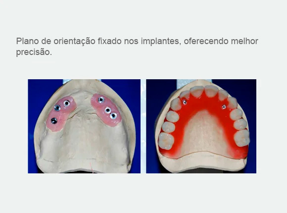 Plano de orientação fixado nos implantes, oferecendo melhor pre
