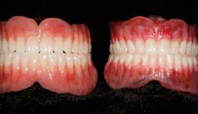 enceramento-stg-e-acrilizacao-labso0081