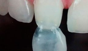 fragmento-e-lente-de-contato-ceramico-labso028111